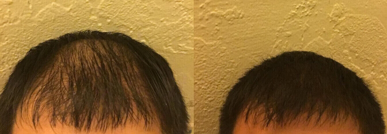 Результаты роста волос у пользователя после использования Lipogaine